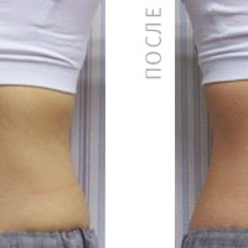 Комплекс "Фракционный RF-лифтинг" лица БЕЗ проколов кожи
                    Косметолог Ирина Киев