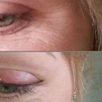 Комплекс "Фракционный RF-лифтинг" лица БЕЗ проколов кожи
                    Косметолог Ирина Киев