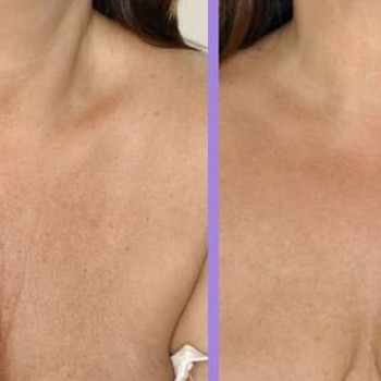 Комплекс "Фракционный RF-лифтинг" лица БЕЗ проколов кожи
                    Косметолог Ирина Киев