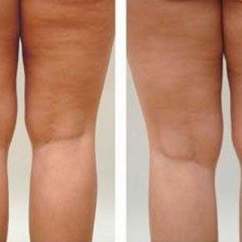 Комплекс "Фракционный RF-лифтинг" лица БЕЗ проколов кожи
                    Косметолог Ирина Киев