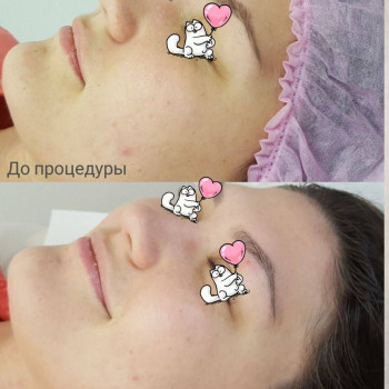 Комплекс "BB GLOW - тональный крем на год"
                    Косметолог Ирина Киев