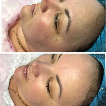 Комплекс "BB GLOW - тональный крем на год"
                    Косметолог Ирина Киев