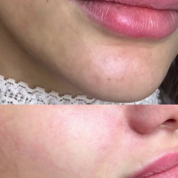 Комплекс "BB GLOW - тональный крем на год"
                    Косметолог Ирина Киев