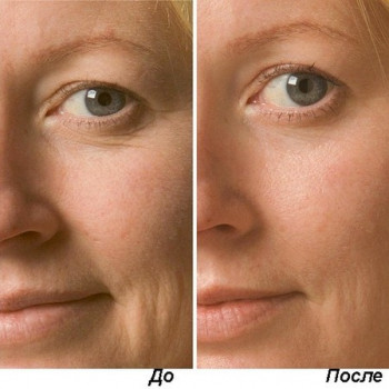 Мезотерапия
                    Косметологический центр Надия Кривой Рог