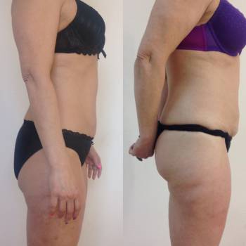 Результат после курса 5 сеансов ручного массажа 5 медово