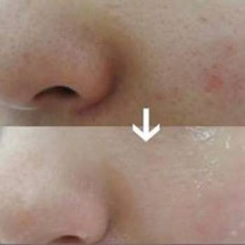 Карбокситерапия – это современная процедура омоло