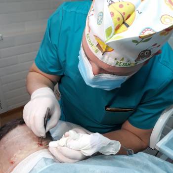 Пересадка волос FUE-метод. Забор донорской зоны.