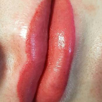 Губы сразу после процедуры