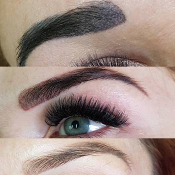 Лазерное удаление перманентного макияжа 
От 500грн