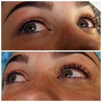 Межресничка