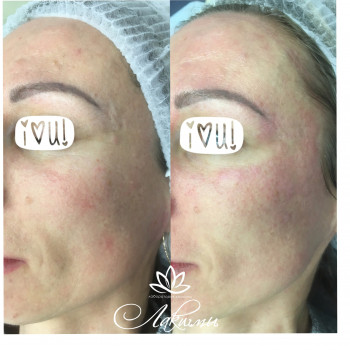 Догляд за обличчям корекціяз моршок косметологія обличчя, фото - косметологічний центр Лакшми