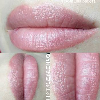 Зажившие губы одна процедура