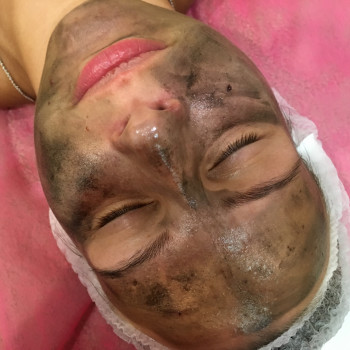 Апаратна косметологія обличчя догляд за обличчям, фото - косметологічний центр Лакшми