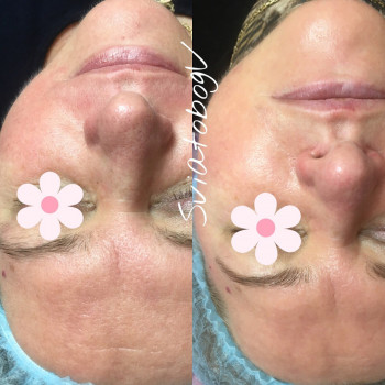 Корекціяз моршок косметологія обличчя, фото - косметологічний центр Лакшми