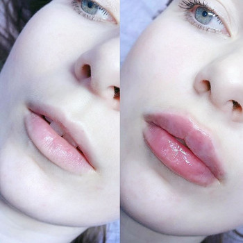 Контурна пластика губ збільшення губ
                    Лікар-косметолог Юлия Харків