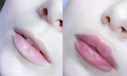 Увеличение губ контурна я пластика губ Лікар-косметолог Юлия Харків