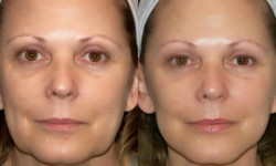 Электропорация (безиньекционная мезотерапия) Косметолог-инъекционист Наталия Одесса