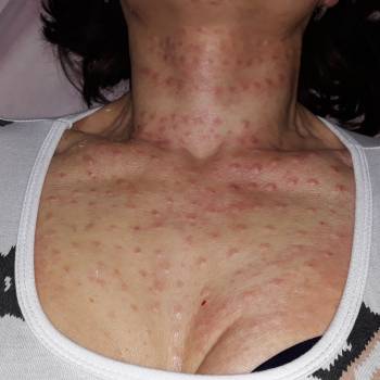 Биоревитализация шеи, зоны декольте