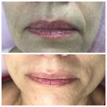 Коррекция носогубной складки.