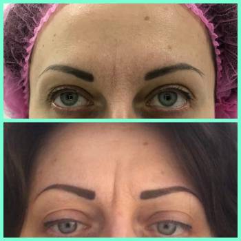 Коррекция межбровного залома