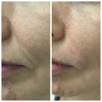 Прямая коррекция борозды с сепарацией.