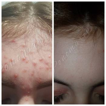 Терапия подросткового АКНЕ.