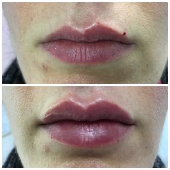 Увеличение губ.