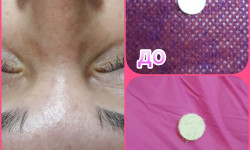 Алмазная микродермабразия Косметолог-ін'єкціоніст Елена Харків