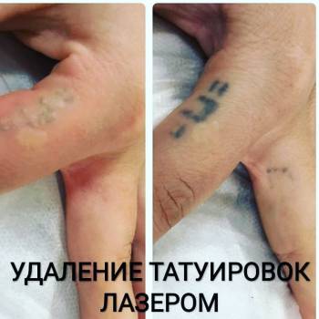 Удаление татуировок