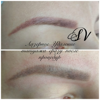 Лазерное Удаление некачественного татуажа
                    Салон краси Studio Shishenko Дніпро