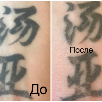 Лазерное Удаление некачественного татуажа
                    Салон краси Studio Shishenko Дніпро