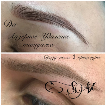 Лазерное Удаление некачественного татуажа
                    Салон краси Studio Shishenko Дніпро