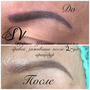 Лазерное Удаление некачественного татуажа
                    Салон краси Studio Shishenko Дніпро