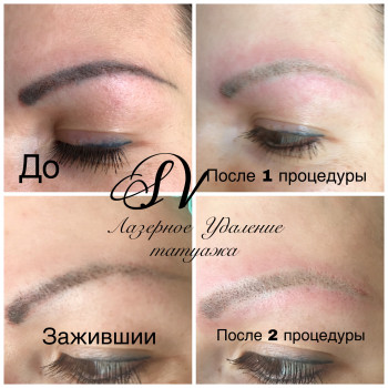 Лазерное Удаление некачественного татуажа
                    Салон краси Studio Shishenko Дніпро