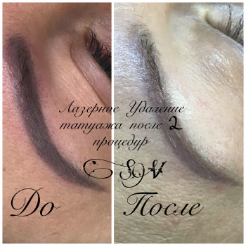 Лазерное Удаление некачественного татуажа
                    Салон краси Studio Shishenko Дніпро