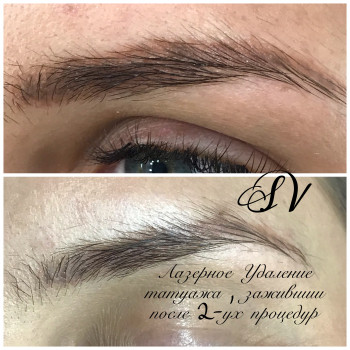 Лазерное Удаление некачественного татуажа
                    Салон краси Studio Shishenko Дніпро