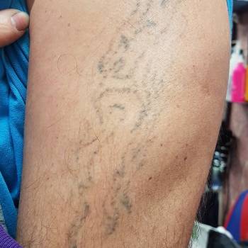 удаление тату