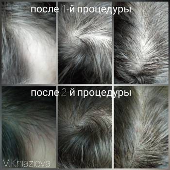 мезотерапия кожи головы