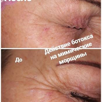 Ботокс 