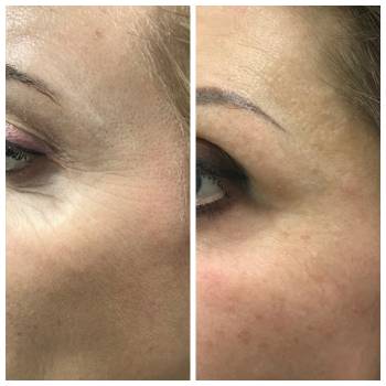 Морщины вокруг глаз