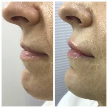 Коррекция формы губ