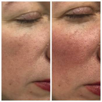 Коррекция носослезной борозды