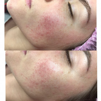 Стоп купероз