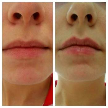 Увеличение губ