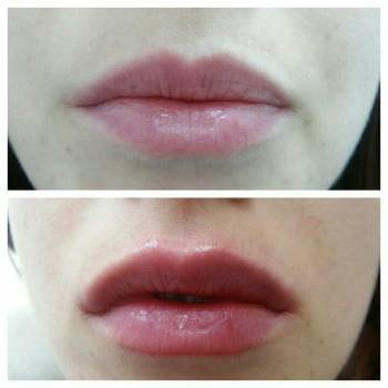 Увеличение губ