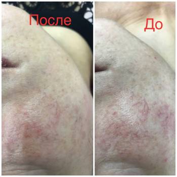 Удаление сосудов "Купероз"