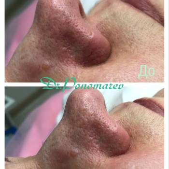 Лечение Купороса