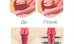 Интимное омоложение СО2 лазером Медицинский центр Доктор Лилиана Одесса