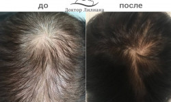 Regenera — революционное лечение облысения Медичний центр Доктор Лилиана Одеса