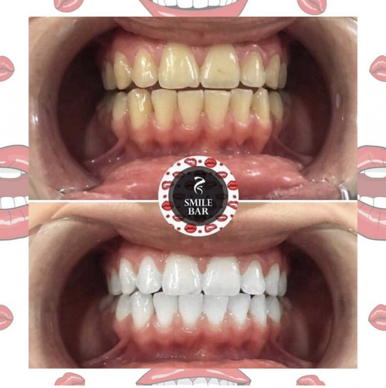 Косметическое Отбеливание зубов , фото - Косметолог Мария Кушниренко